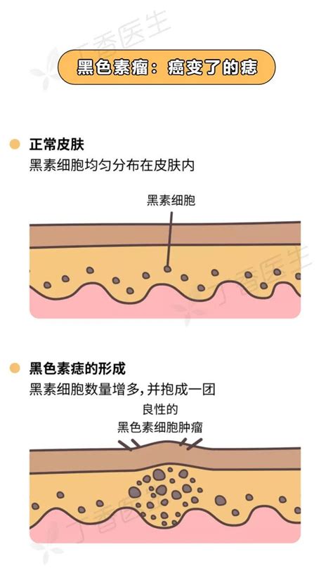 痣出血|痣也可能会癌变！长在 3 个地方要注意